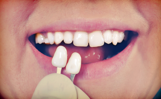 dca-blog_article-46_veneers-and-dental-health